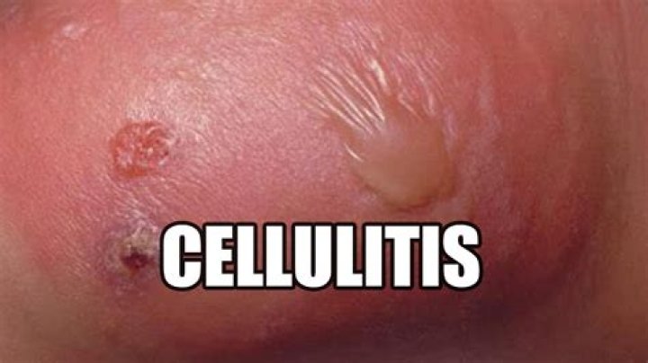 Can a boil cause cellulitis