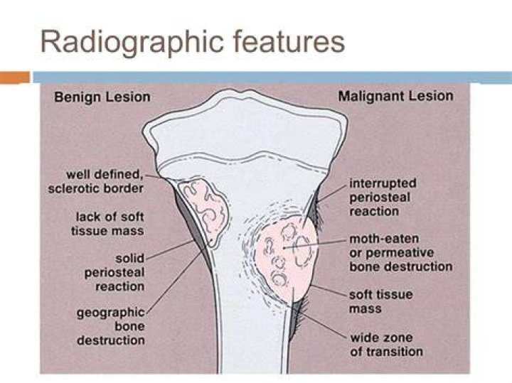 Can an osteochondroma come back