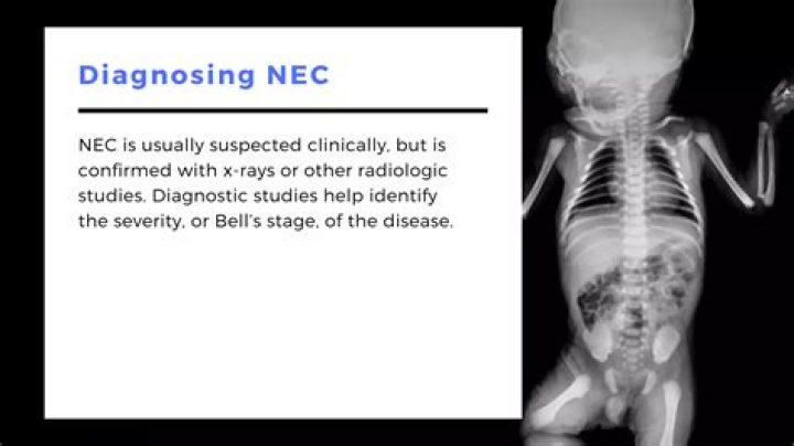 Can babies die from NEC