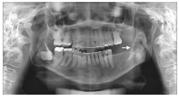 Can bone calcification be reversed