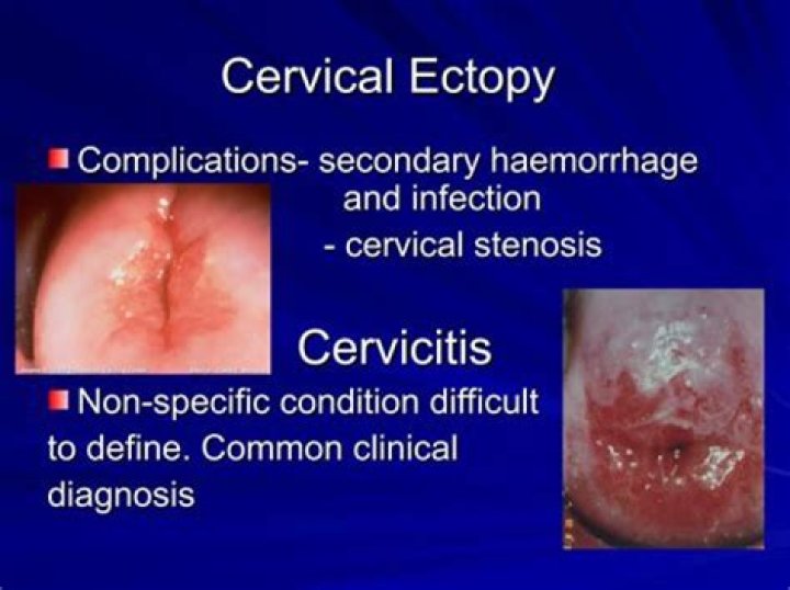 Can low estrogen cause cervicitis
