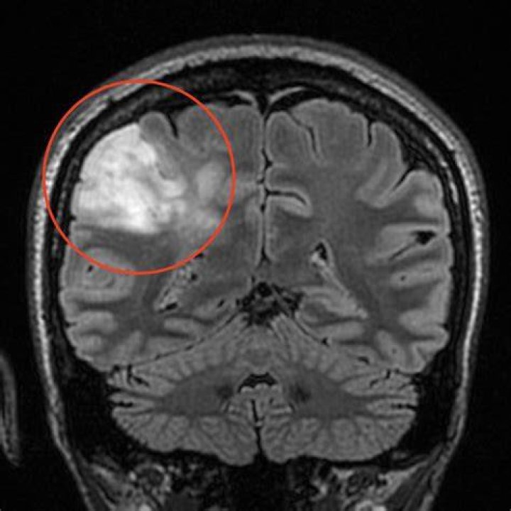 Can oligodendroglioma be cured