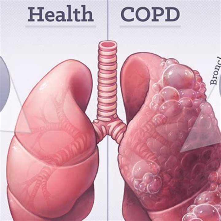 Can oxygen make COPD worse