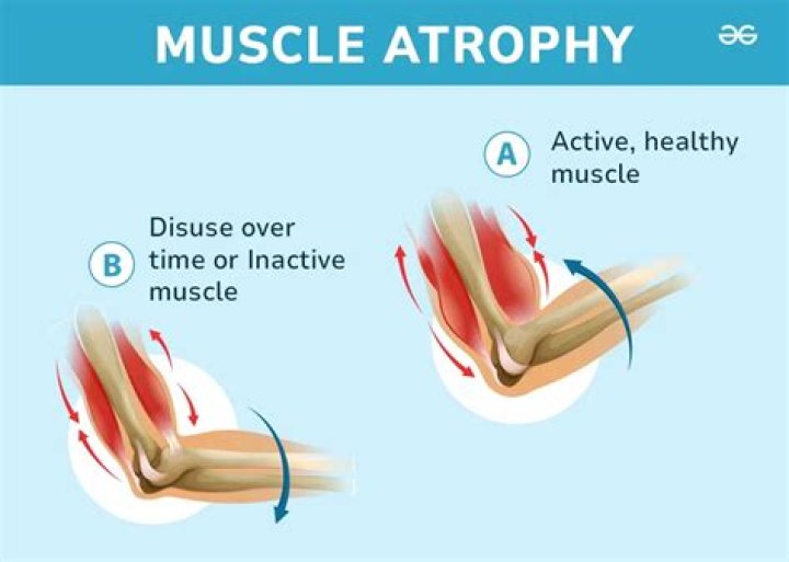 Can sciatica cause muscle atrophy