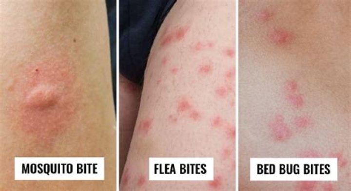 Can you get sick from bed bug bites