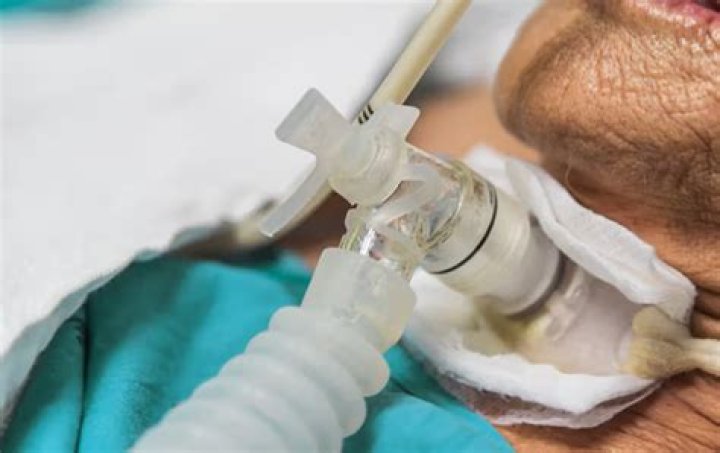 Does a tracheostomy replace a ventilator