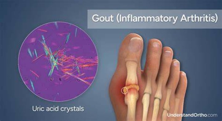 Does bread affect gout