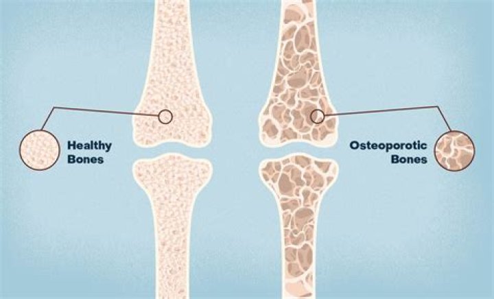 Does Strontium help osteoporosis