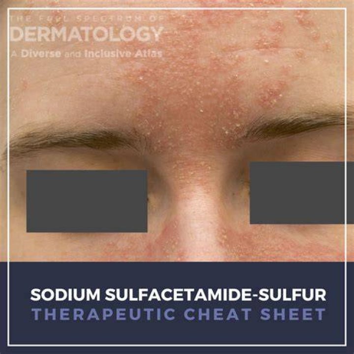 Does sulfacetamide work for acne