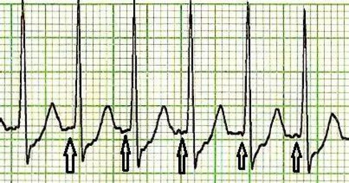 Does SVT have P waves