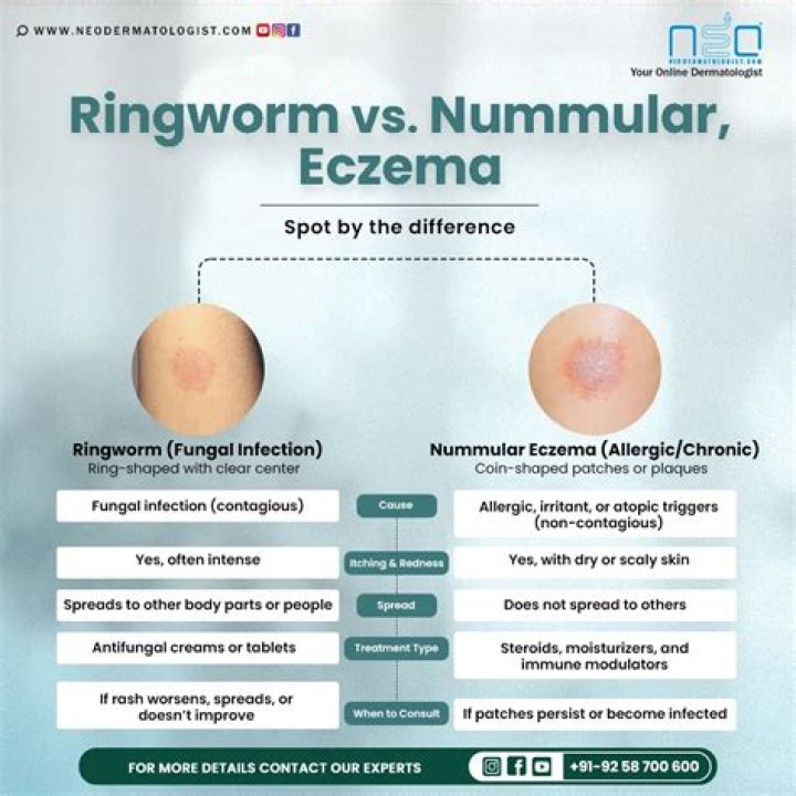How can I prevent Nummular eczema