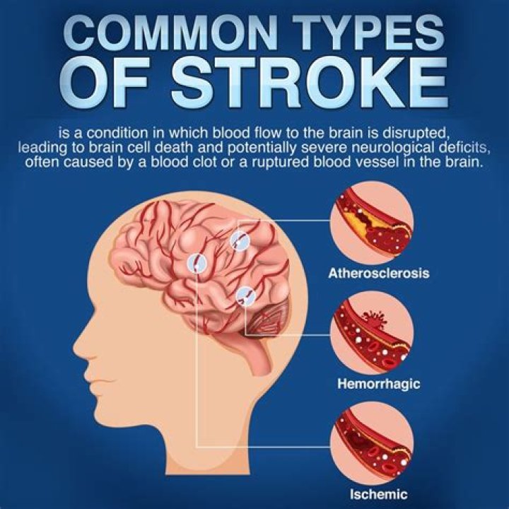 How common is dysphagia after stroke