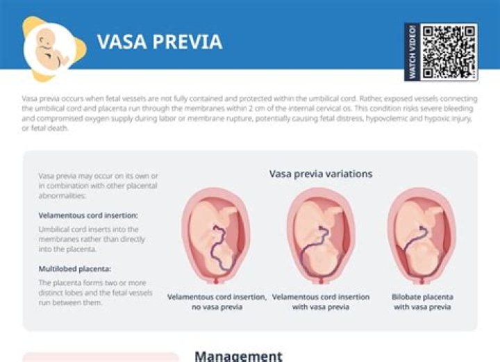 How dangerous is vasa previa