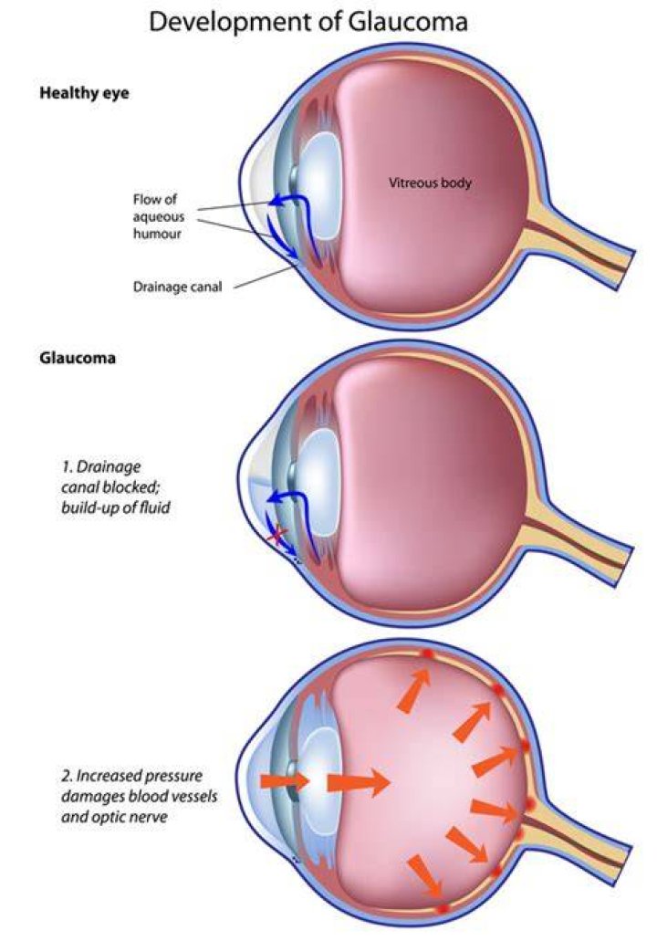 How do Miotics help glaucoma