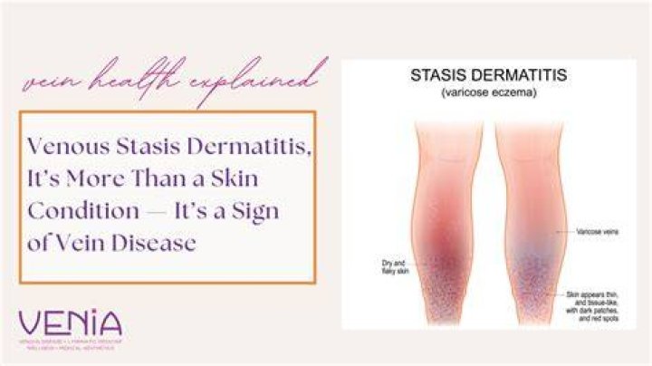 How do you cure stasis dermatitis