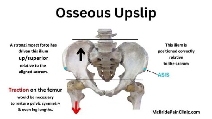 How do you fix a hip Upslip