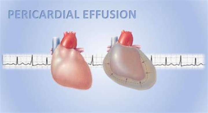 How do you fix a pericardial effusion