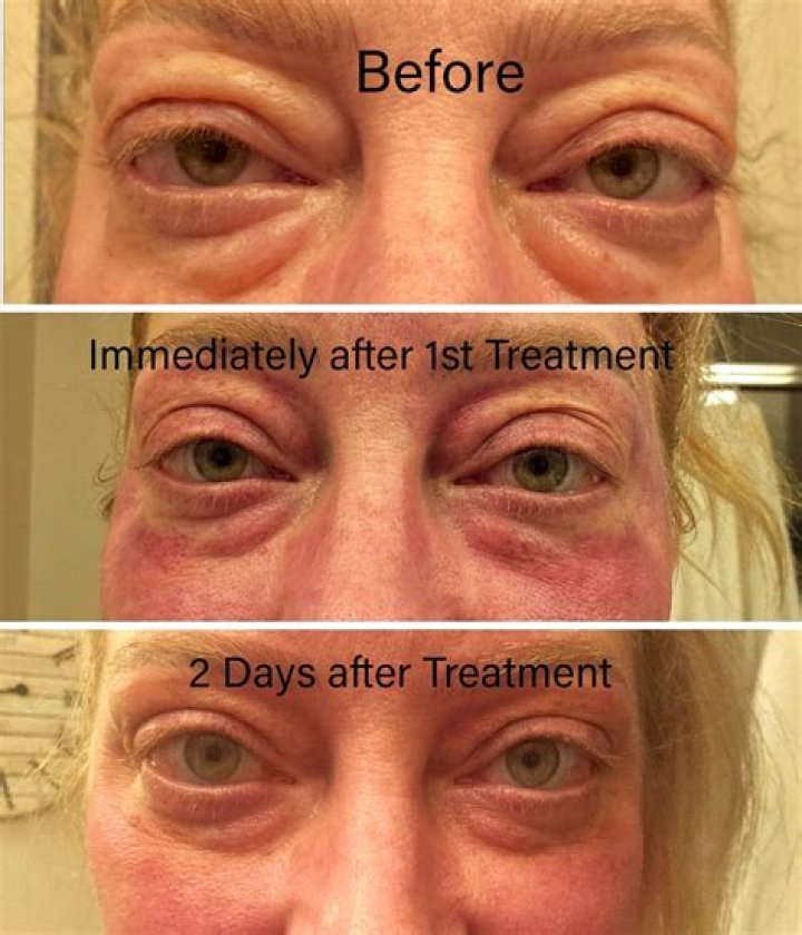 How do you stop periorbital edema
