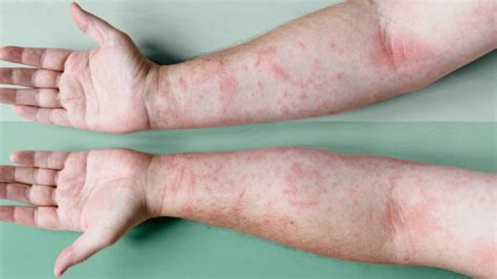 How does eczema Herpeticum start