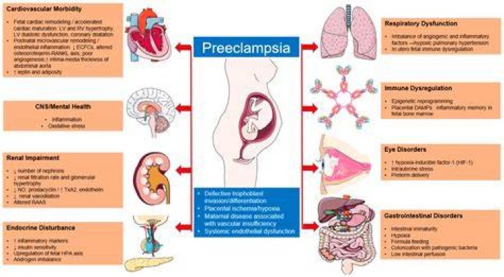 How fast can preeclampsia develop