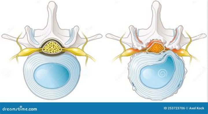 How is a herniated nucleus pulposus diagnosed