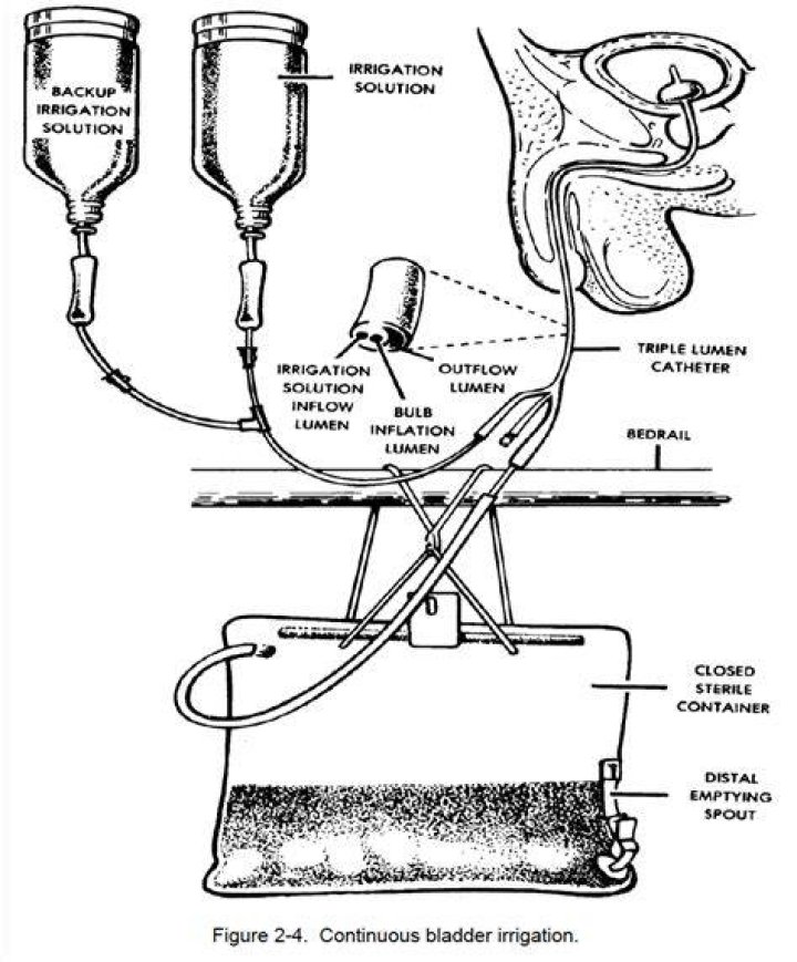 How is continuous bladder irrigation done