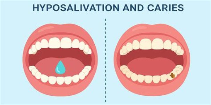 How is Hyposalivation treated