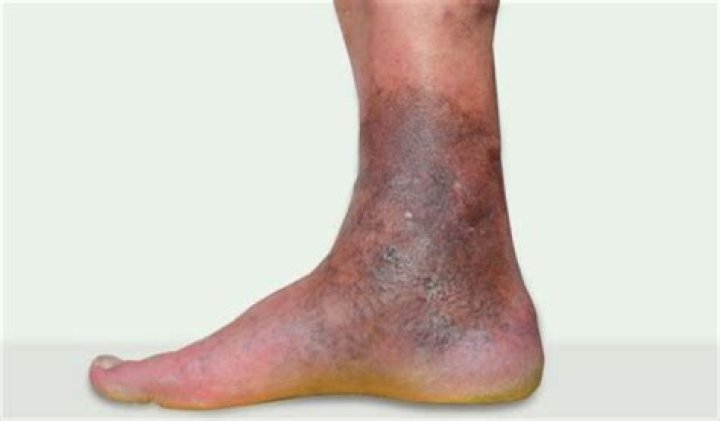 How is Lipodermatosclerosis treated