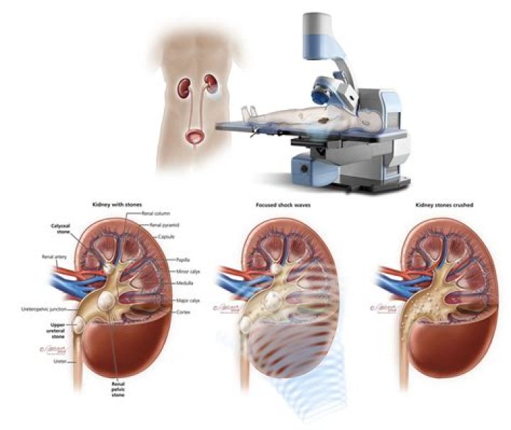 How lithotripsy is done