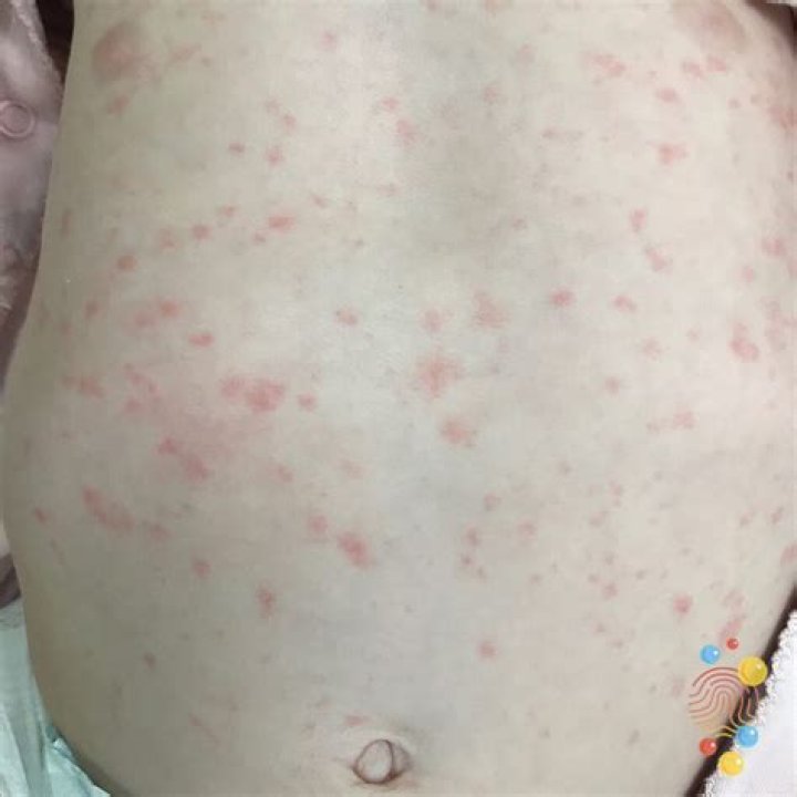 How long does a roseola rash last