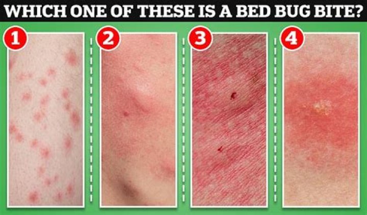How long does bed bug bites last