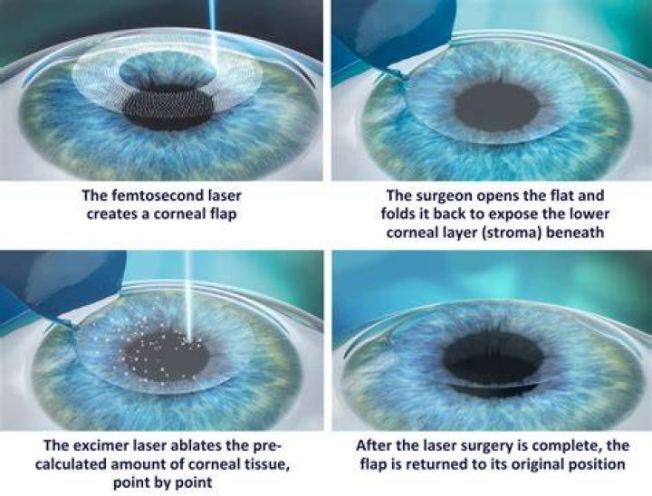How much does laser Lasik cost