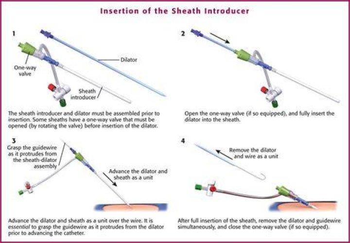 Is a Cordis a sheath