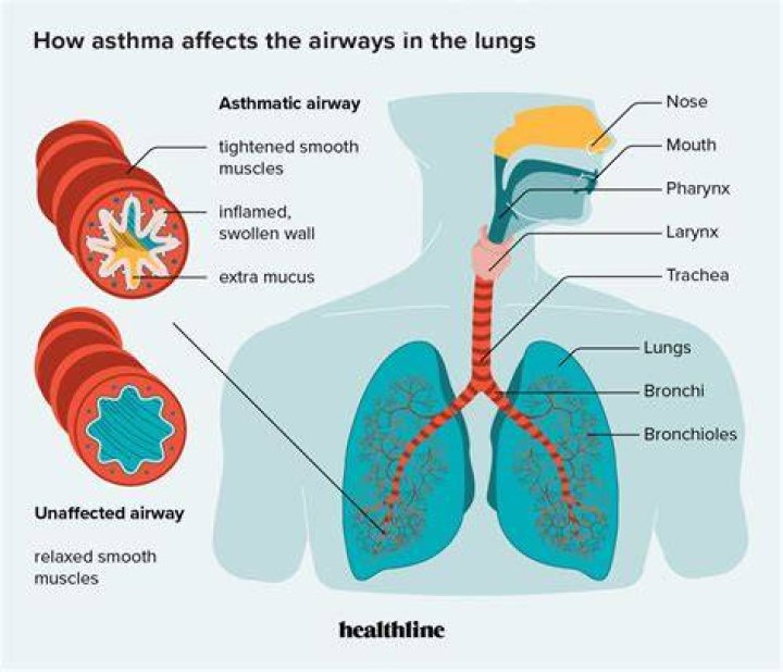 Is asthma and bronchitis the same thing