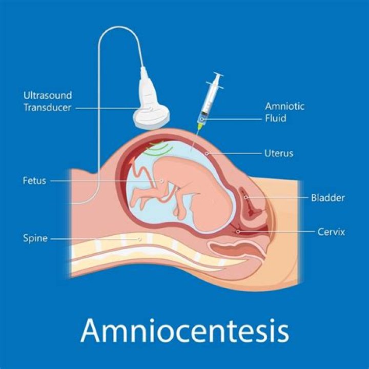 Is CVS riskier than amniocentesis
