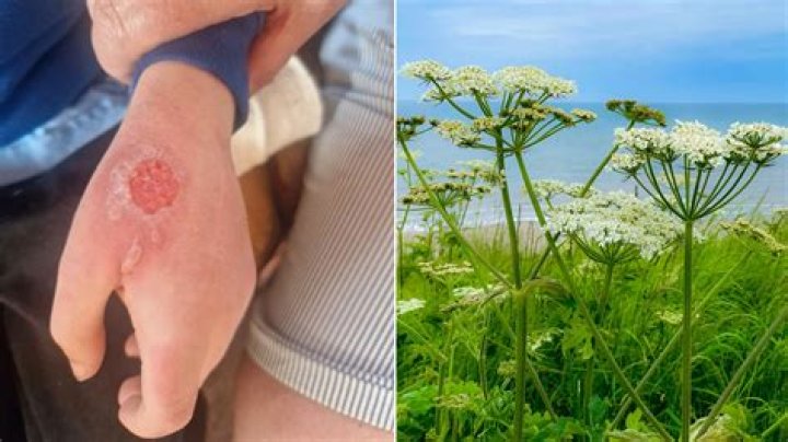 Is hogweed dangerous