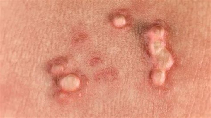 Is HPV an STD