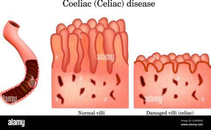 Is it celiac or celiac