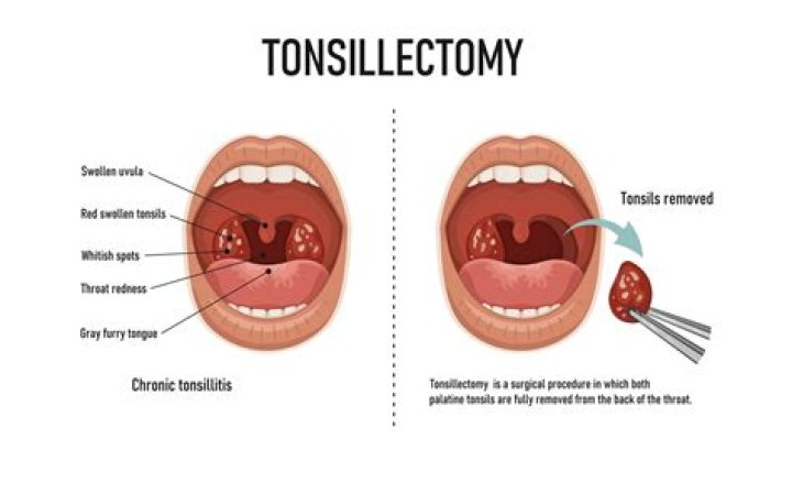 Is it normal to get a cold after a tonsillectomy
