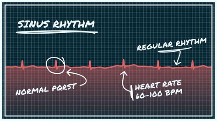 Is normal sinus rhythm good