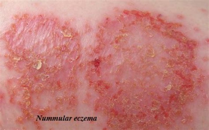 Is Nummular Eczema an autoimmune