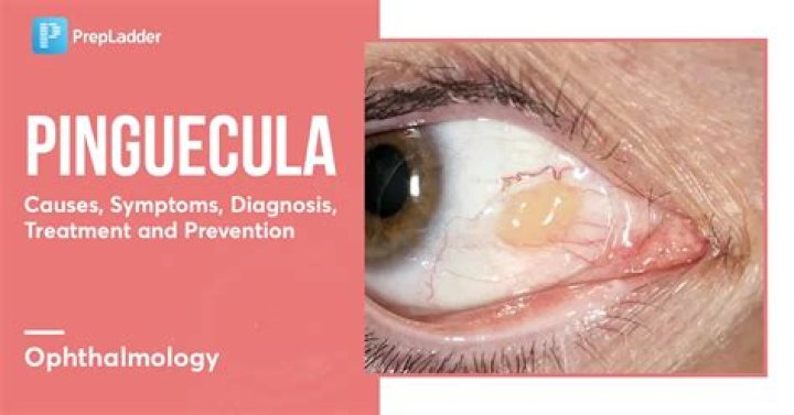 Is Pinguecula contagious