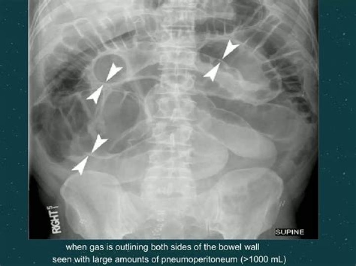 Is Pneumoperitoneum serious