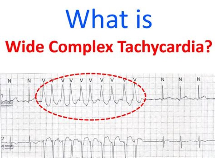 Is SVT wide or narrow complex