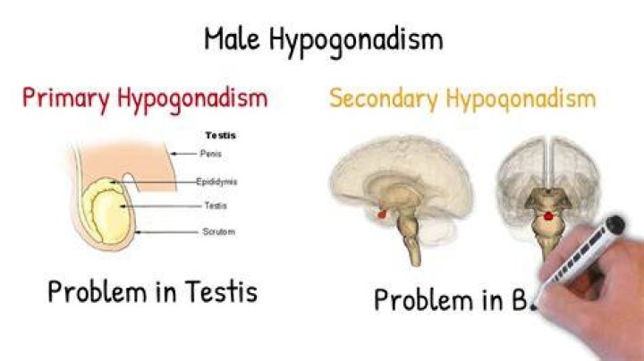 Is Testicular Hypofunction the same as hypogonadism