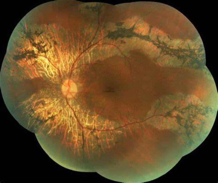 Is the choroid pigmented