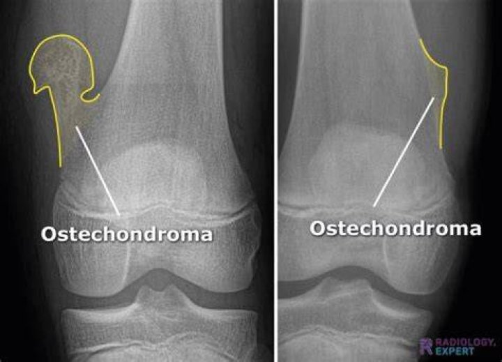 Should an osteochondroma be removed