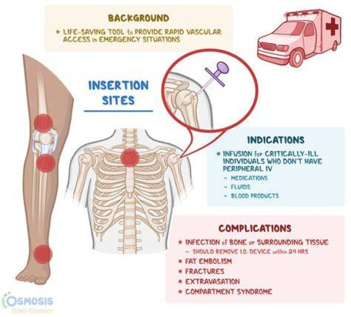 What are the indications for IO insertion