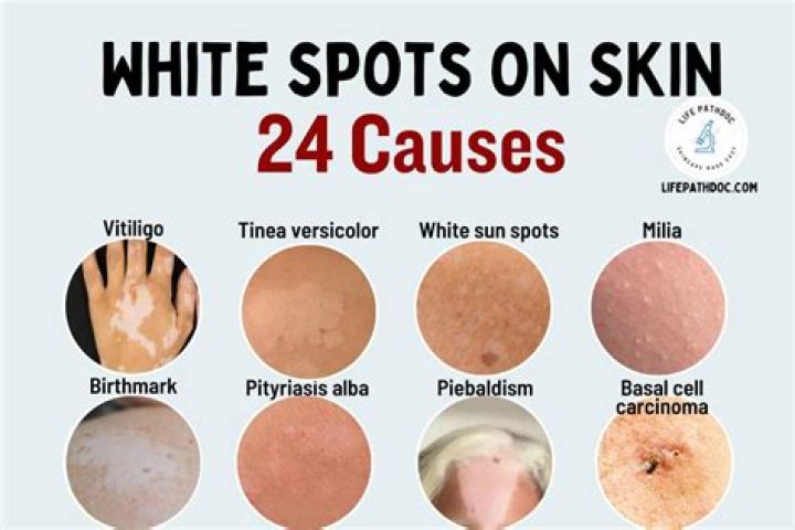 What are the white spiders