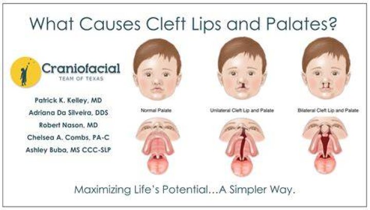 What causes a cleft palate